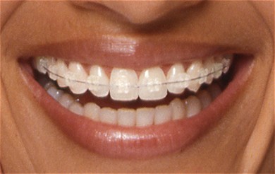 bagues dentaires céramique