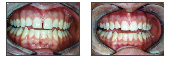 orthodontie diasteme
