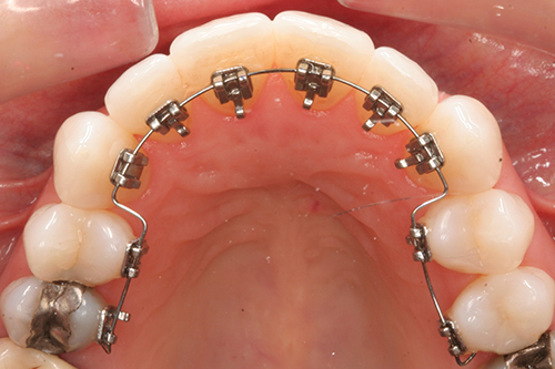 orthodontie linguale adulte