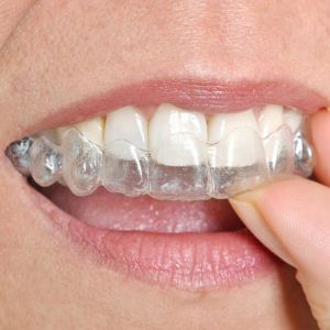 orthodontie adulte gouttière invisalign