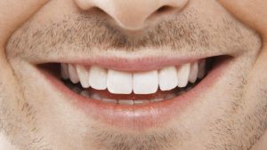 Orthodontie adulte : rajeunir votre sourire c’est encore possible