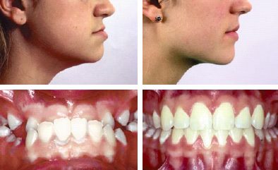 Orthodontie ado et adulte : Corriger l'alignement dents définitives - Dr  Gilbert