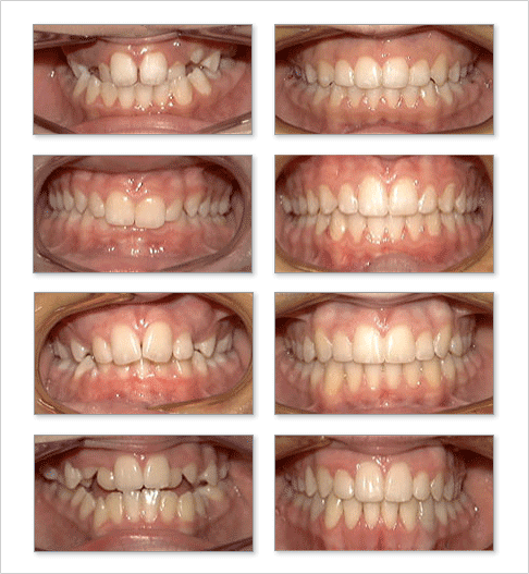 exemples orthodontie adulte
