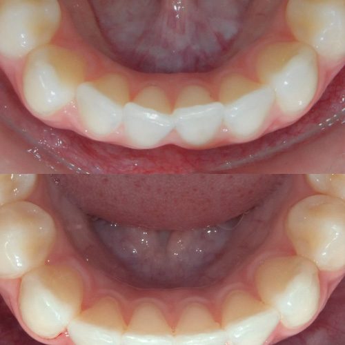 orthodontie invisalign