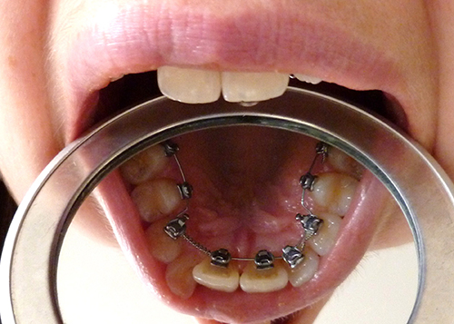 orthodontie linguale supérieure