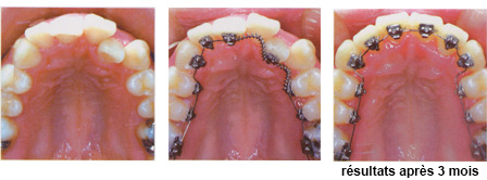Orthodontie pour adulte : le business de l'appareil dentaire
