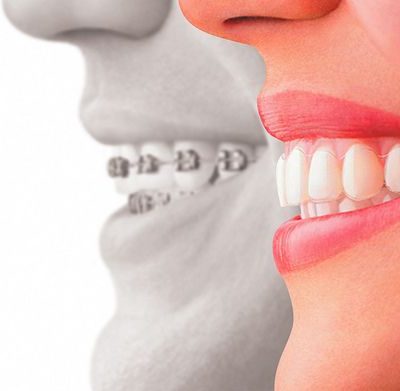 Quels sont les inconvénients d'une gouttière dentaire ?