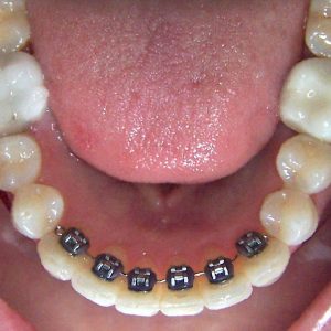 orthodontie adulte