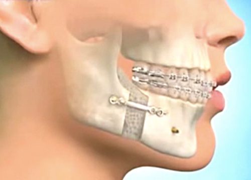 orthodontie adulte chirurgie orthodontique