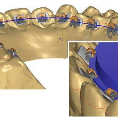 simulation 3D orthodontie linguale