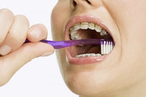 hygiene orthodontie