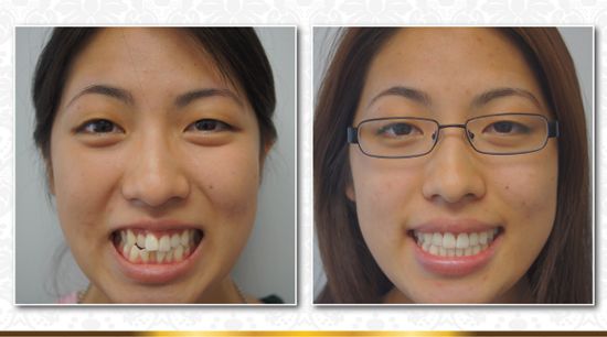 Invisalign avant après